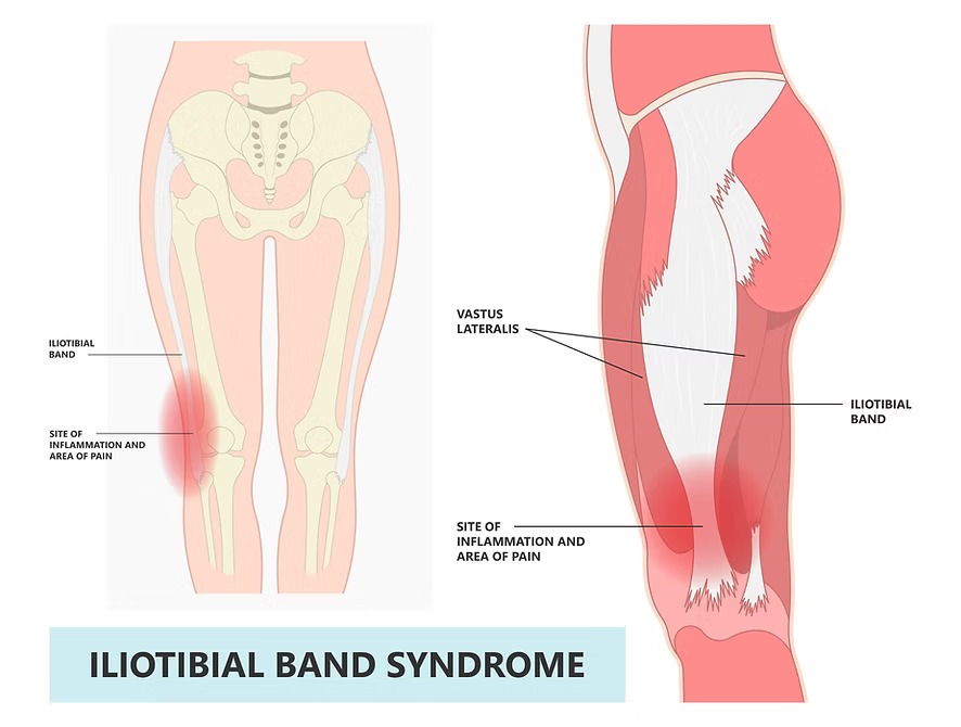 Iliotibial Band Syndrome (ITBS): A Common Overuse Injury